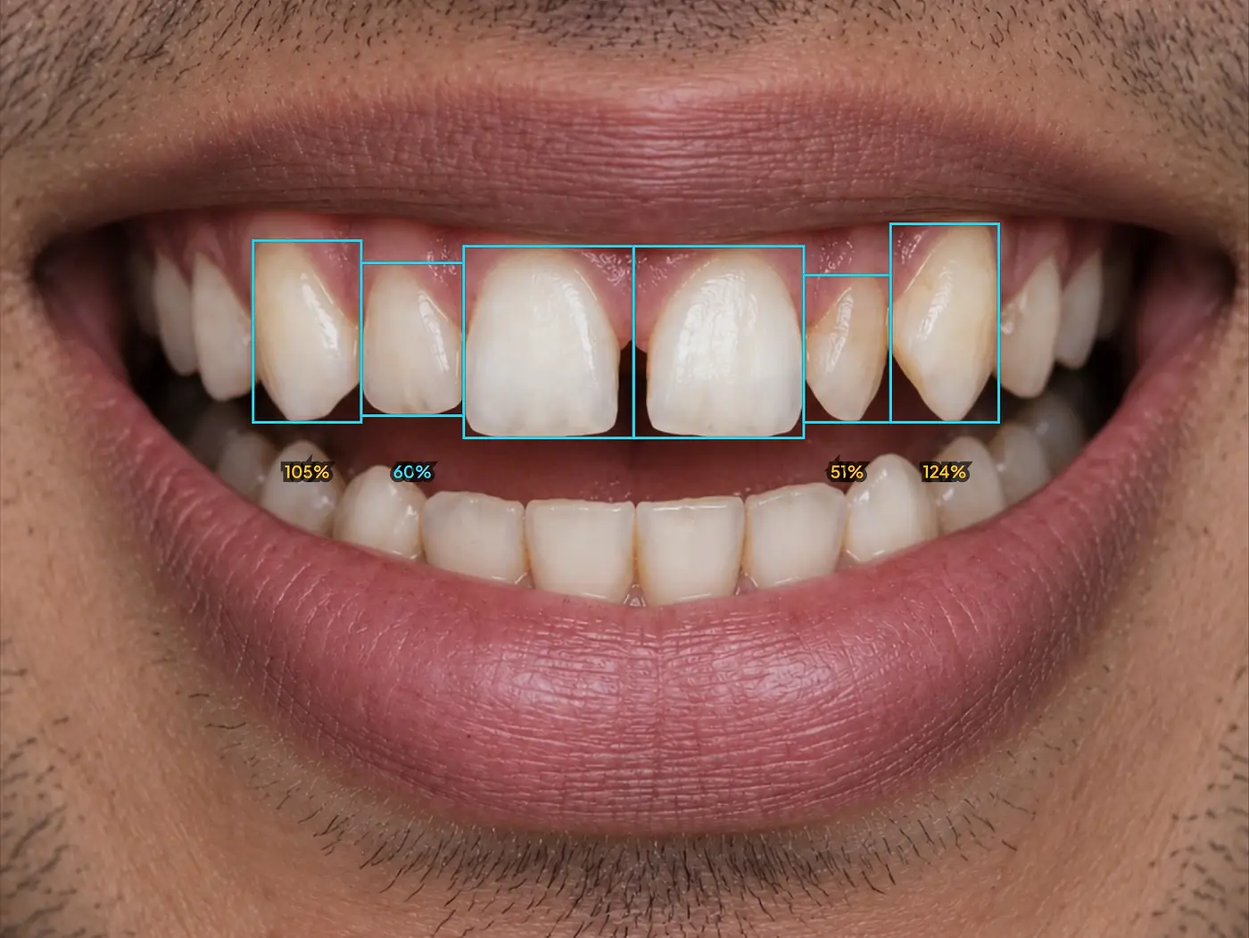 Grade de proporção da Resyn sobre os seis dentes da frente de um paciente-modelo, com a largura de cada dente dividida pela do vizinho
