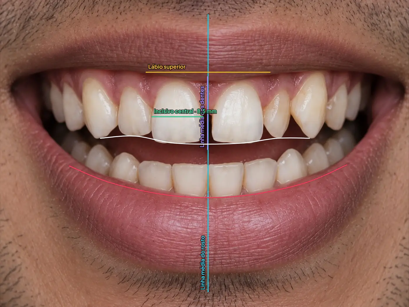Planejamento digital do sorriso na Resyn: sorriso com a linha média do rosto, a linha média dos dentes, a linha do lábio superior e a régua medida no incisivo central, com 8,5 mm
