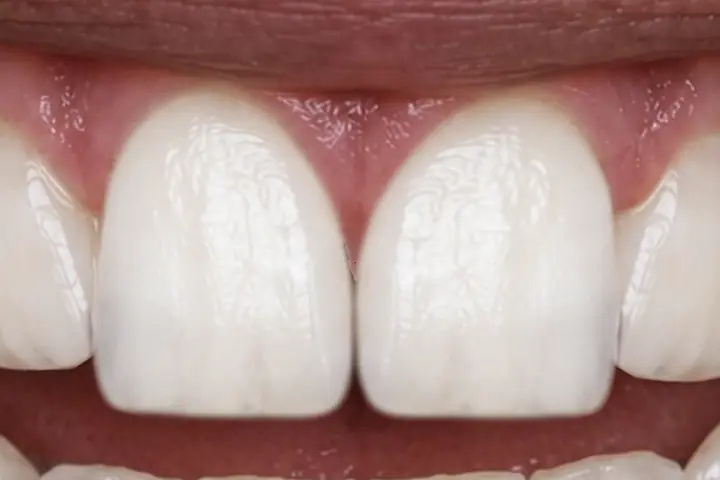 Simulação: o espaço fechado com os dentes do próprio paciente.