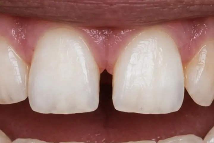 Hoje: os dentes da frente como estão.